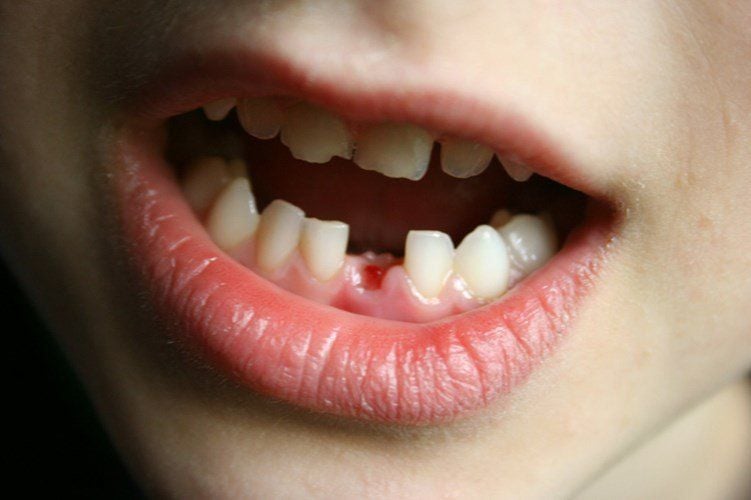 Răng bị gãy do cấu trúc răng yếu