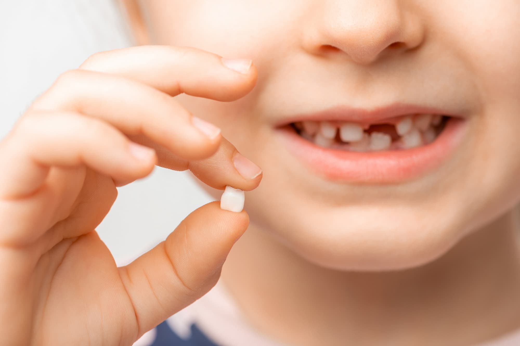 Khắc phục tình trạng trẻ em bị gãy răng