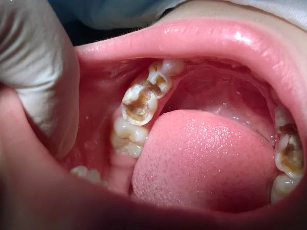 Răng hàm có tác dụng gì và trẻ bị sâu răng hàm có mọc lại không