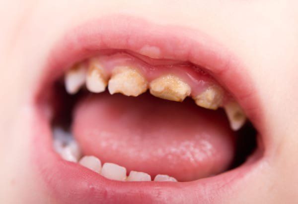 Thời gian để trẻ mọc lại răng