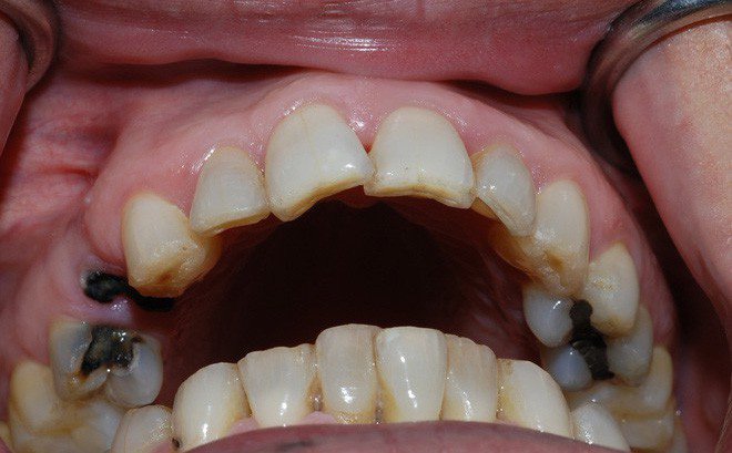 Nguyên nhân khiến cho trẻ em bị sâu răng hàm