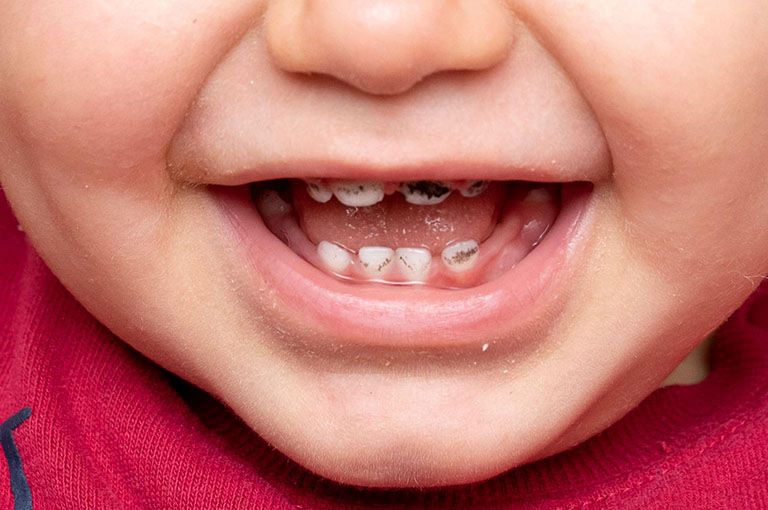 Tùy vào loại sâu răng mà răng trẻ có mọc lại hay không