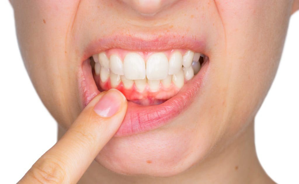 Chảy máu chân răng có thể dấu hiệu bệnh nha chu