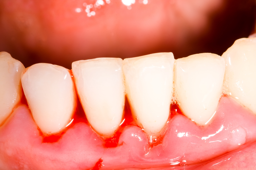 Chảy máu chân răng gây hôi miệng có thể gây nguy hiểm