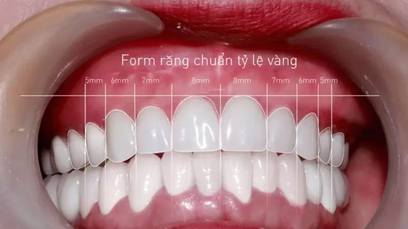 Cung răng đẹp
