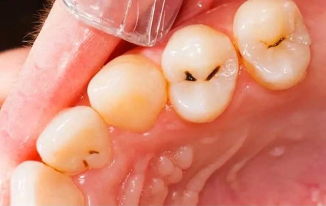 Các nguyên nhân trẻ bị sâu răng