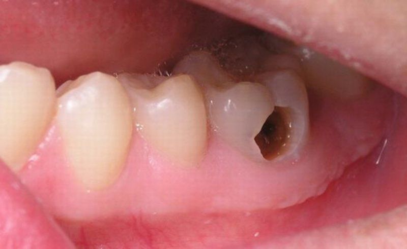 Trẻ bị sâu răng ăn vào tủy: Dấu hiệu, cách điều trị