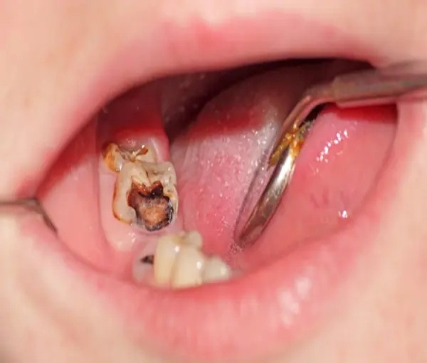 Cách phòng ngừa trẻ bị sâu răng ăn vào tủy