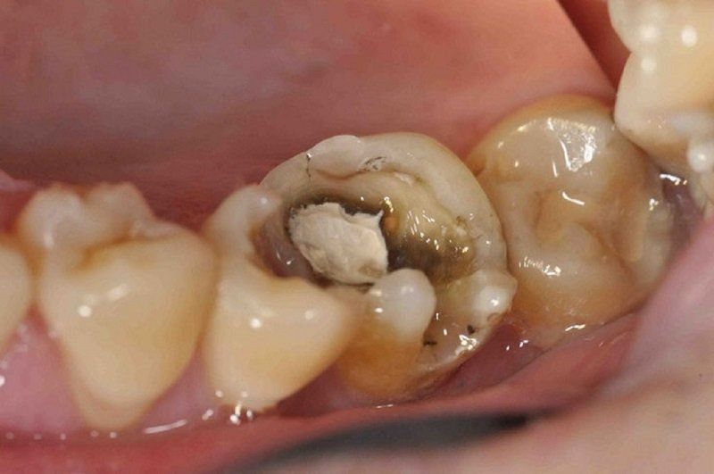 Tủy răng thối là hiện tượng tủy bị hoại tử