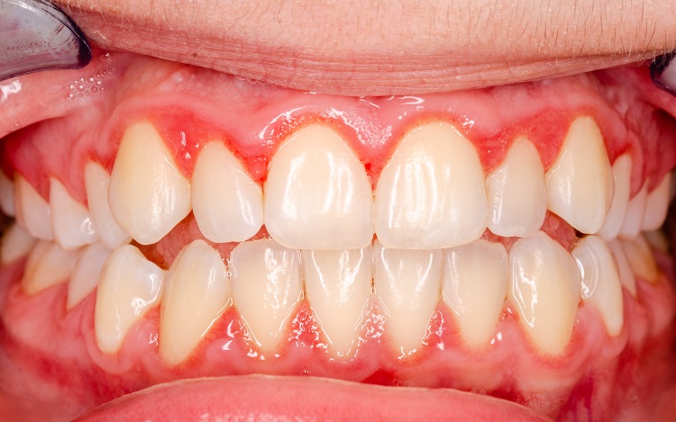 Giai đoạn đầu nướu viêm nhẹ