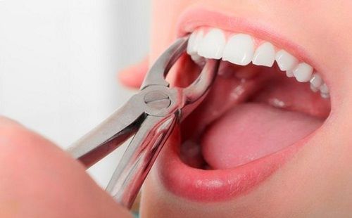 Nhổ răng là các cuối cùng khi tủy răng bị thối