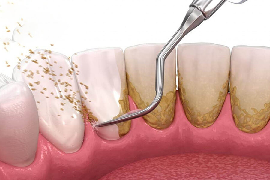 Cao răng xuất hiện trên răng