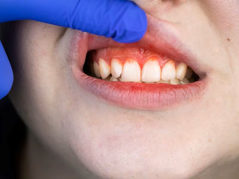 Chảy máu chân răng gây khó chịu cho người bệnh