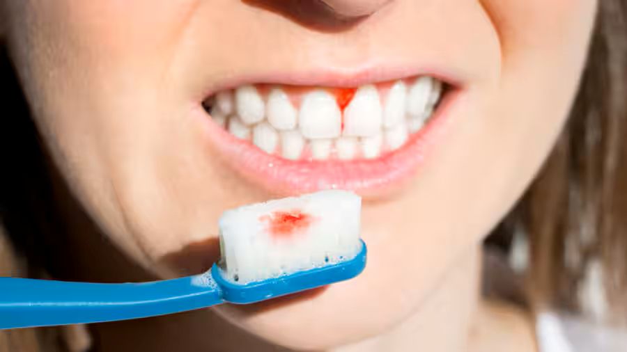 Các nguyên nhân gây chảy máu răng khi đánh răng