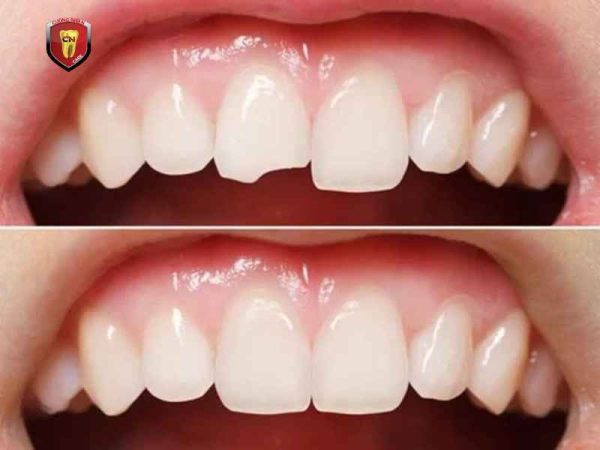 Nguyên nhân làm cho răng trám bị gãy là gì ?
