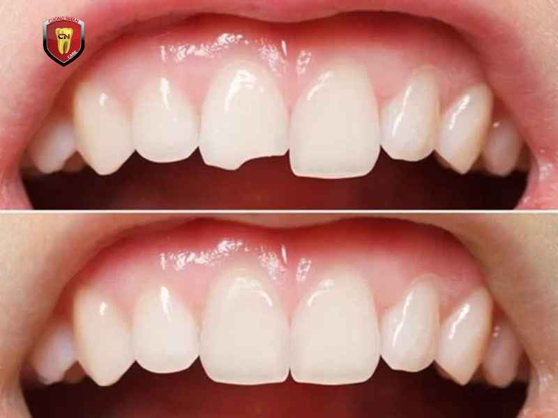 Nguyên nhân làm cho răng trám bị gãy là gì ?