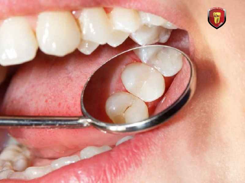 Cách phòng ngừa tình trạng răng trám bị gãy trong tương lai