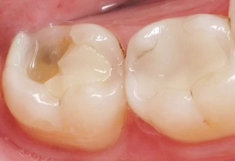 Nhức răng tầm 3-5 ngày là hết
