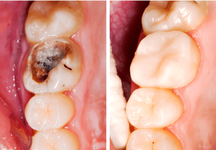 Tình trạng răng miệng trước khi trám bị tổn thương quá lớn