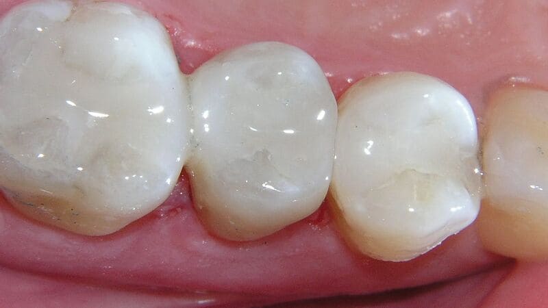 Trám răng tạm thời để làm gì