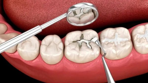 Các vật liệu trám răng tạm thời phổ biến hiện nay