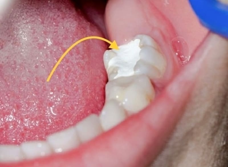 Các lý do cần phải trám răng tạm thời
