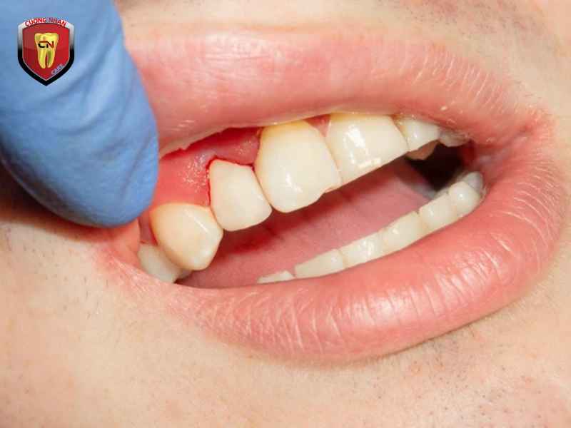 Vì sao khi mang thai phụ nữ dễ dính các bệnh về răng miệng ?