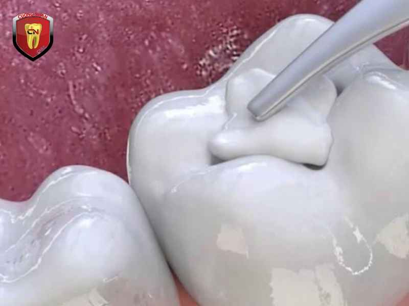Vật liệu dùng để trám răng có ảnh hưởng đến thai nhi không ?