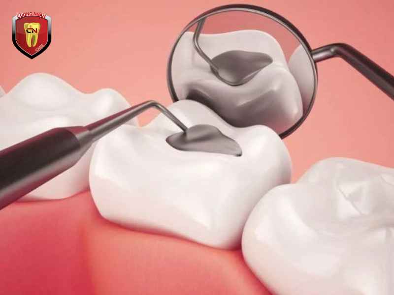 Bảo hiểm y tế có chi trả trám răng không?