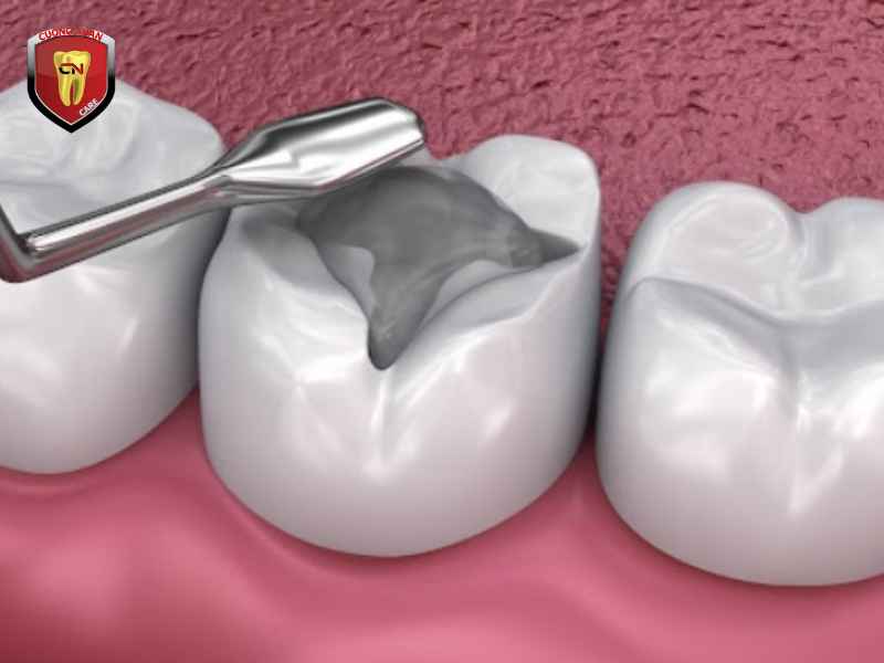 Quy trình sử dụng bảo hiểm y tế khi trám răng