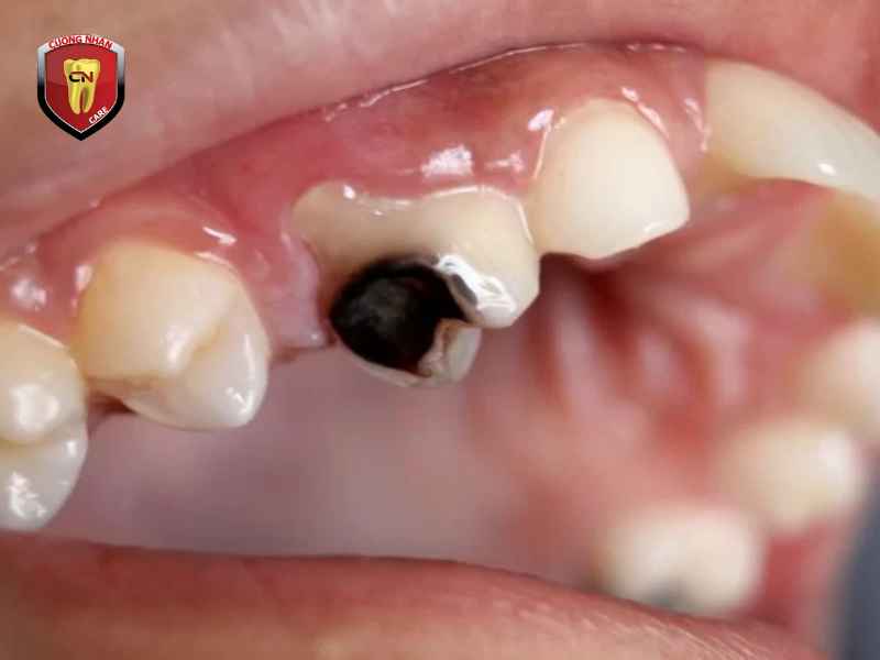 Tác hại của trám răng bị đen