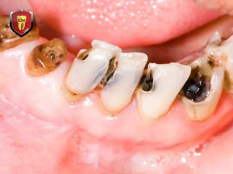 Nguyên nhân bị đen sau khi trám răng là gì?