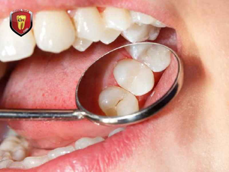 Cách khắc phục tình trạng trám răng bị đen hiệu quả