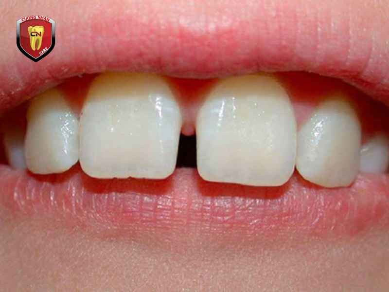 Nguyên nhân làm cho răng bị thưa hở kẽ là gì ?