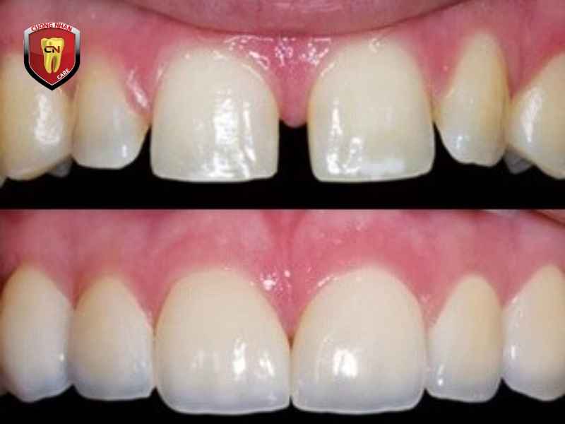 Lợi ích của việc trám răng thưa giữa 2 kẽ răng