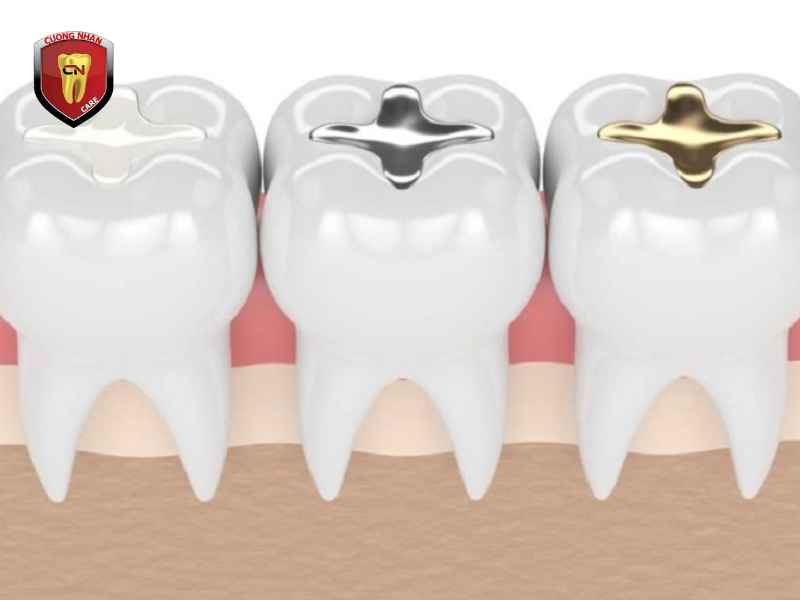 Các loại vật liệu dùng để trám răng