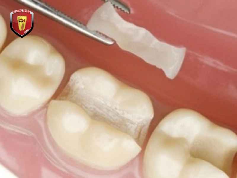 Miếng trám răng thưa sẽ tồn tại bao lâu ?