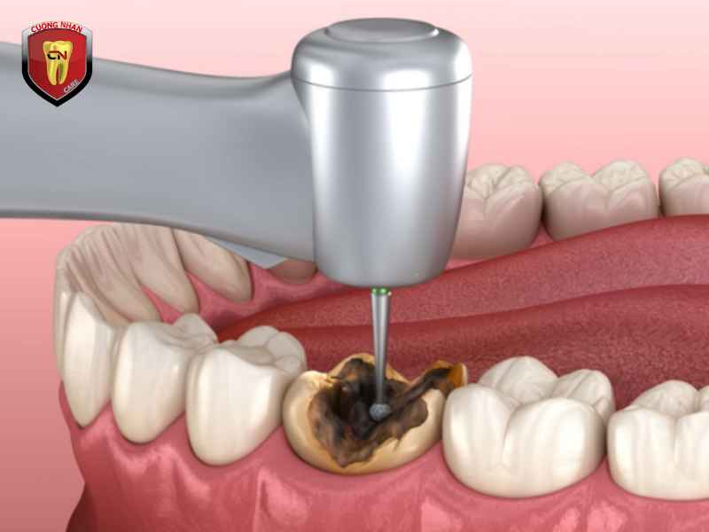 Nha khoa Cường Nhân - chuyên trám hàn răng thẩm mỹ