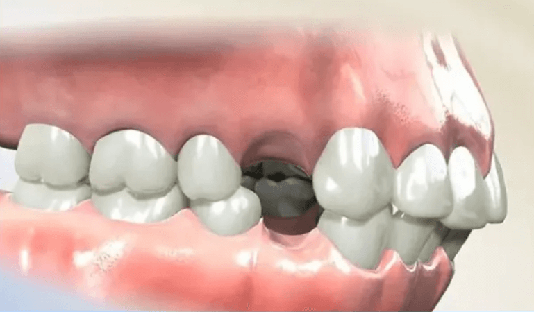 Vị trí của răng số 4 trên cung hàm