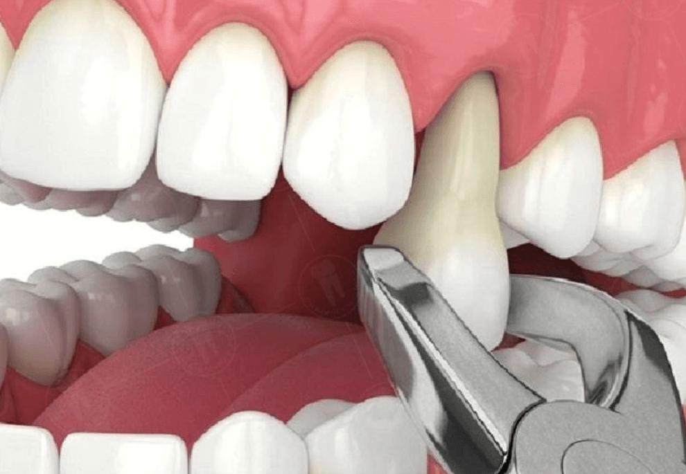 Có nên nhổ răng số 4 không