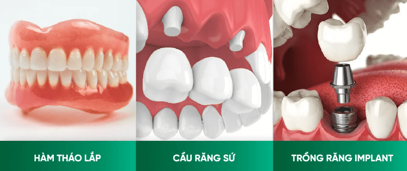 Các phương pháp phục hồi răng số 4 hiện nay