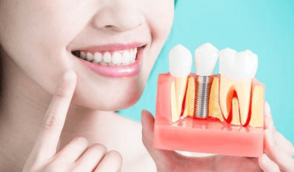 Trồng răng Implant