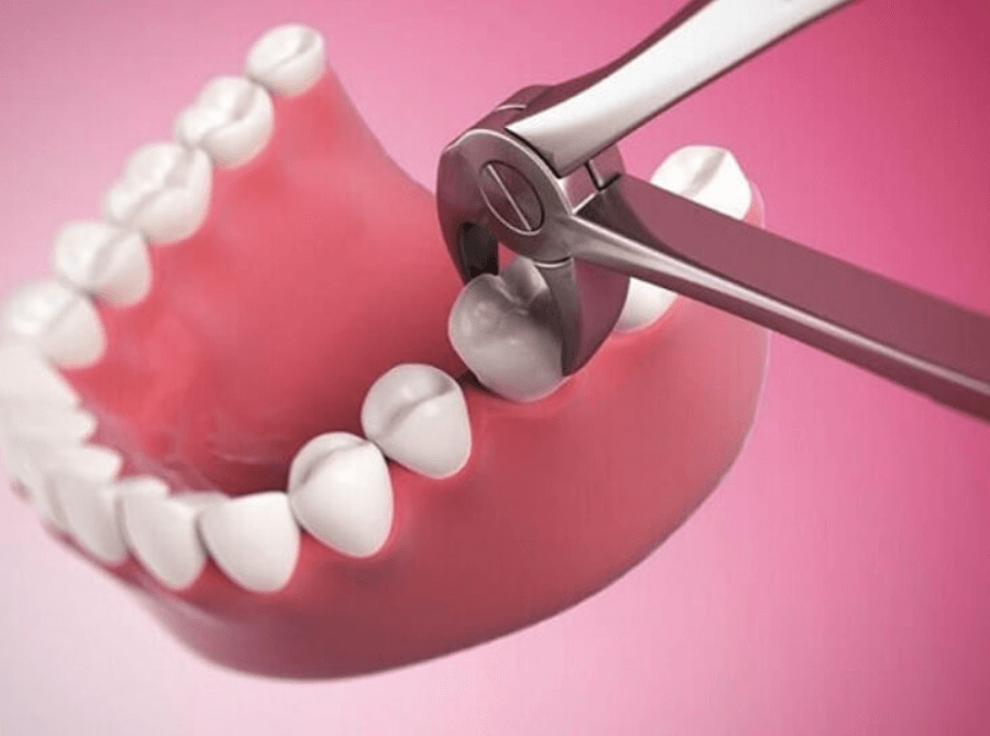 Các trường hợp phải nhổ răng số 5