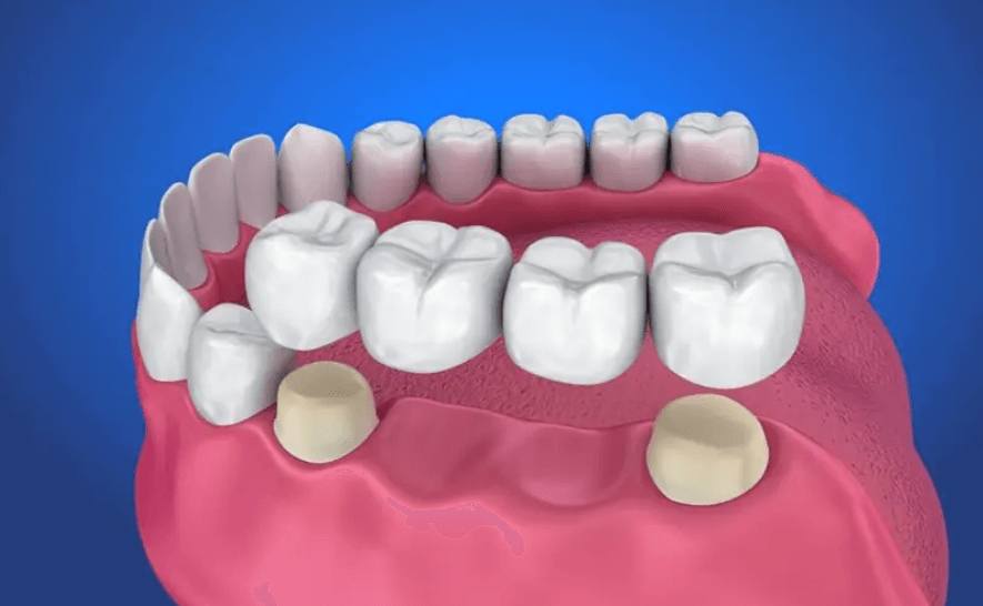 Không nhổ răng số 5 khi cần thiết sẽ gây hậu quả nghiêm trọng