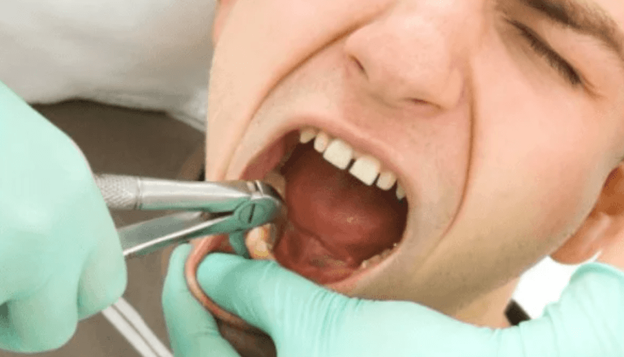 Những hậu quả nghiêm trọng khi mất răng số 5