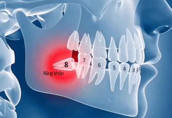 Răng số 8-răng khôn