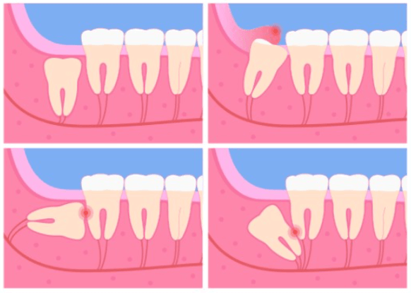 Các dạng mọc của răng số 8
