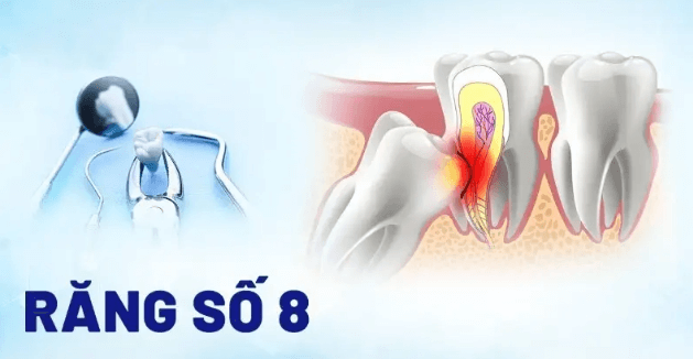 Vì sao răng số 8 gây ra nhiều biến chứng nghiêm trọng?