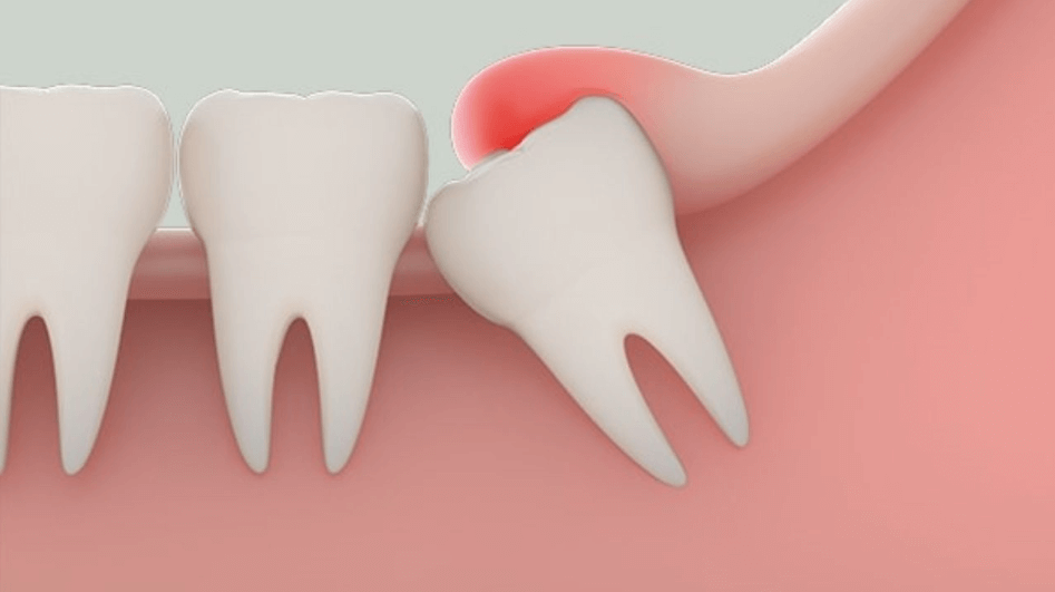 Nhổ răng số 8 có nguy hiểm không ?