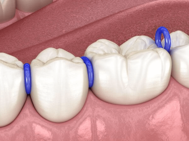 Thun tách kẽ cao su